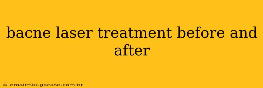 bacne laser treatment before and after