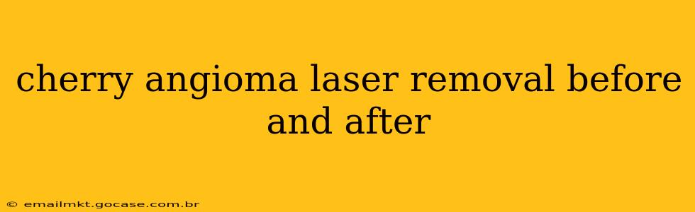 cherry angioma laser removal before and after