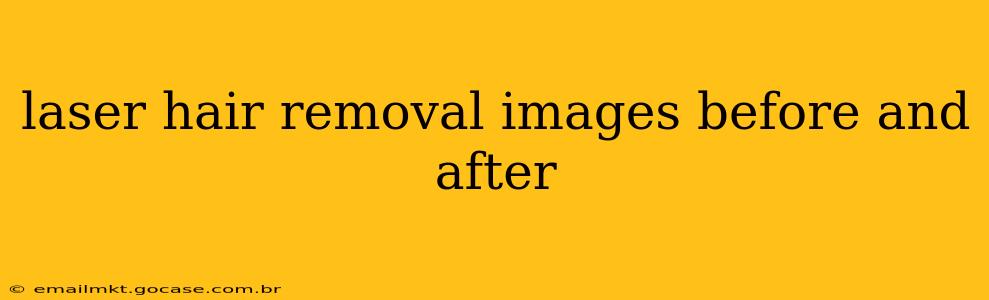 laser hair removal images before and after
