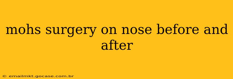 mohs surgery on nose before and after