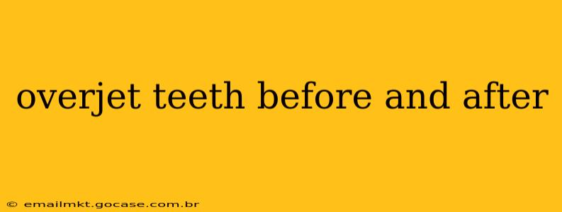 overjet teeth before and after
