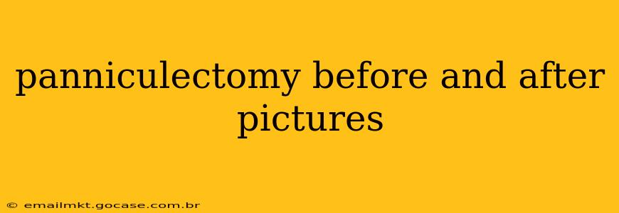 panniculectomy before and after pictures