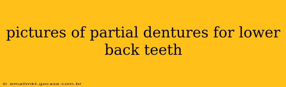pictures of partial dentures for lower back teeth