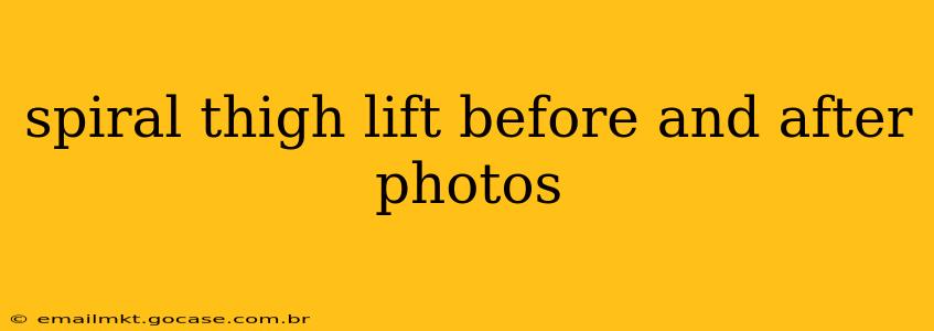 spiral thigh lift before and after photos