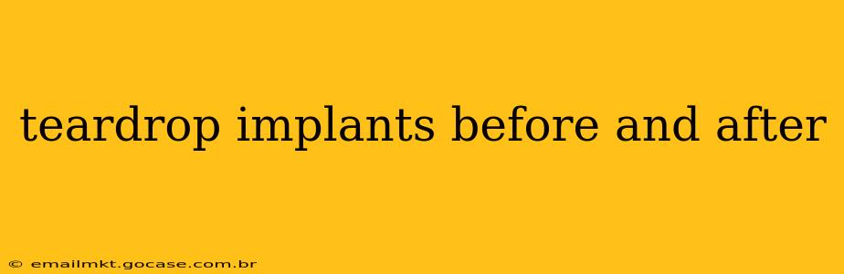 teardrop implants before and after