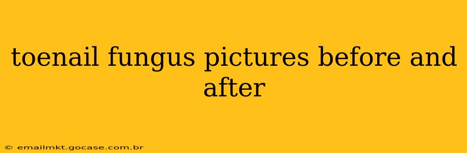toenail fungus pictures before and after