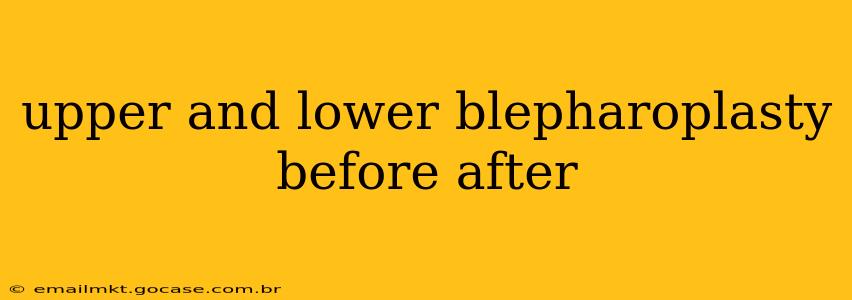 upper and lower blepharoplasty before after